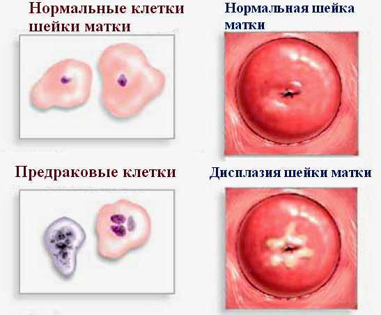 Дисплазия шейки матки